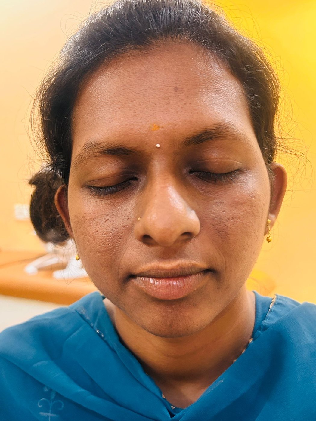 Acne Healing Journey after image