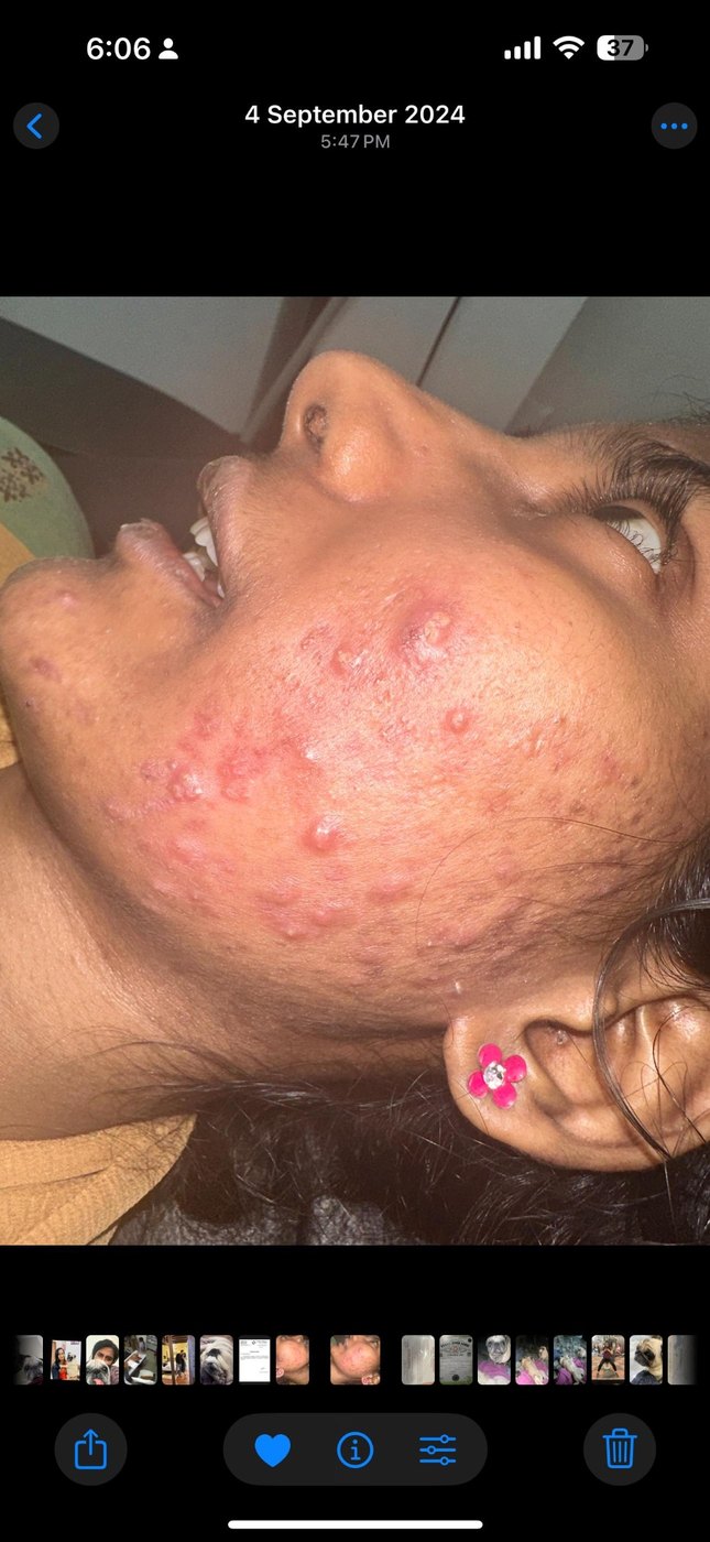 Acne Healing Journey before image
