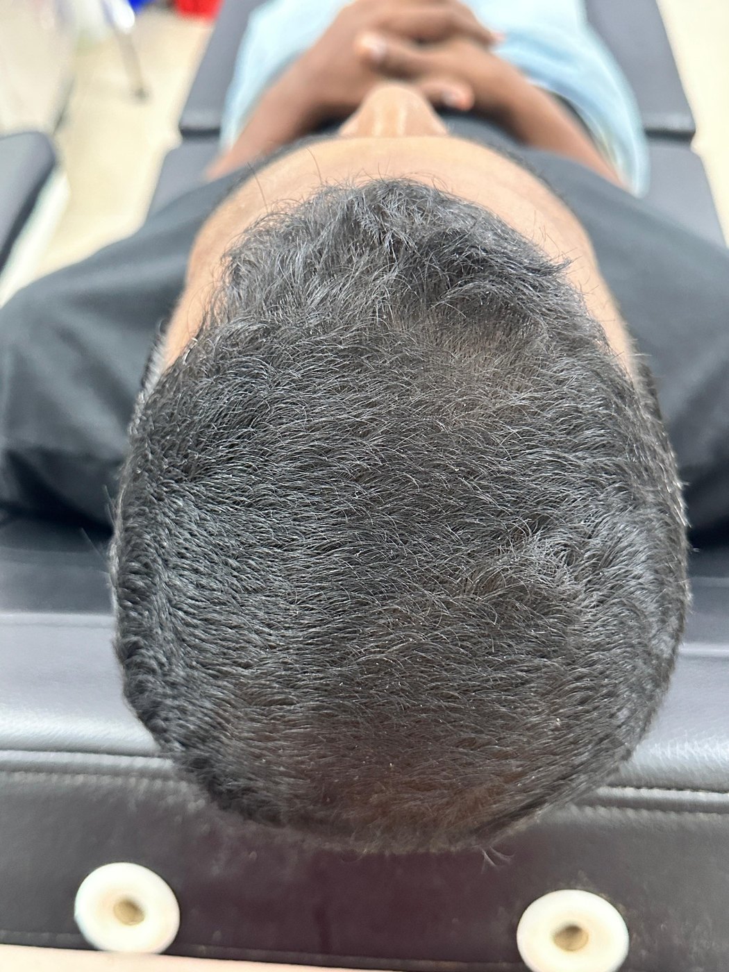 Hair Restoration Progress after image