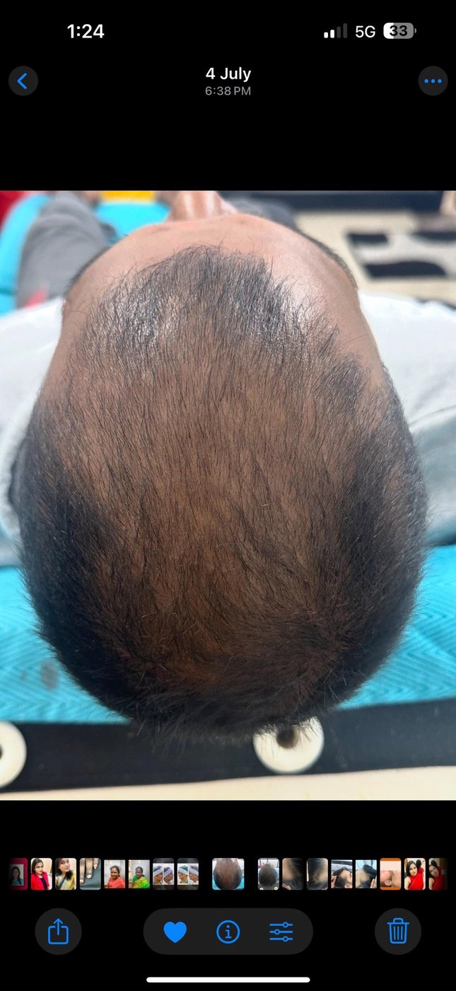 Hair Restoration Progress before image
