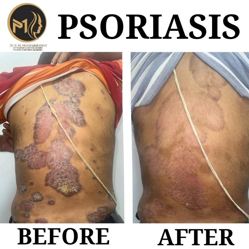 Psoriasis Body Care Result before after result