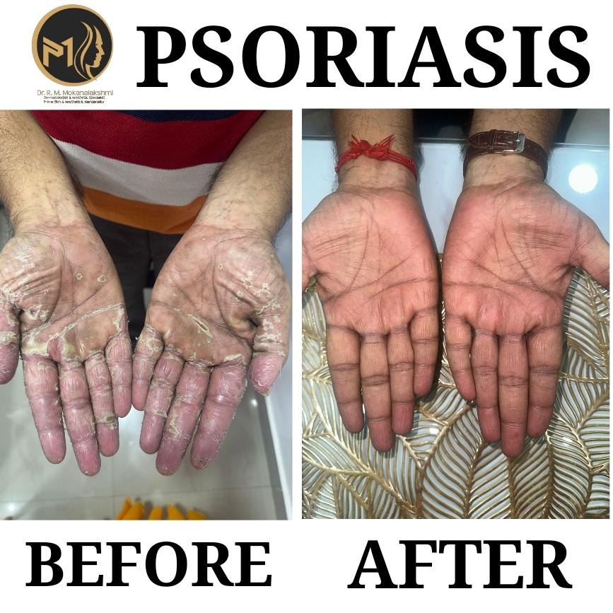 Psoriasis Hand Care Result before after result
